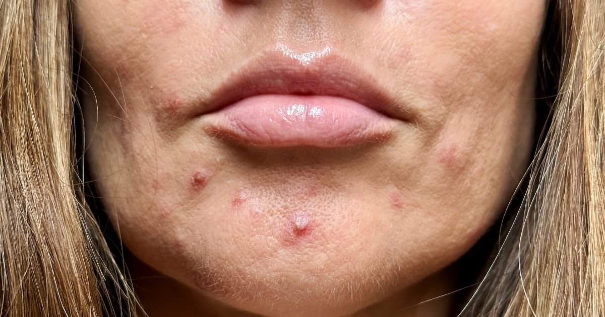 Acné después de los 30: por qué aparece y cómo tratarlo correctamente